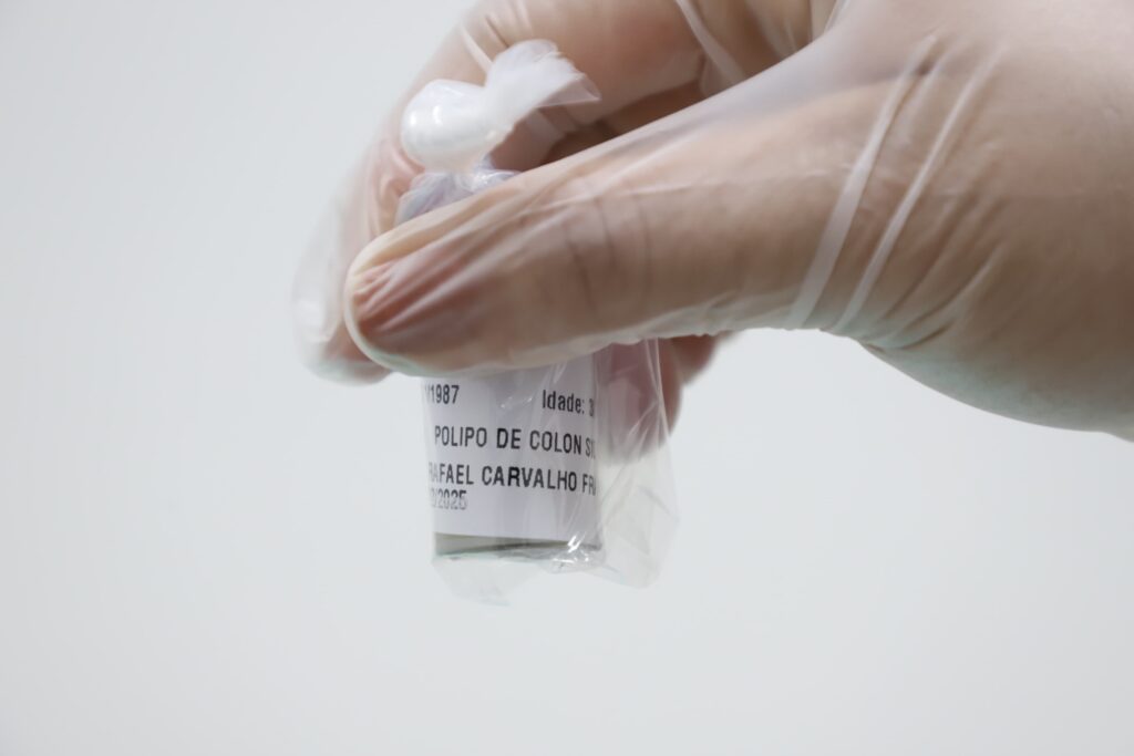 Saúde promove mutirão de prevenção ao câncer de intestino Saúde promove mutirão de prevenção ao câncer de intestino